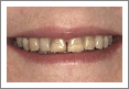 Before Porcelain Veneer