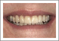 After Porcelain Veneer