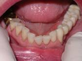 Sevenoaks Dentist Implants