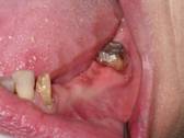 Sevenoaks Dentist Bridges