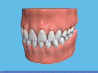 Implants After